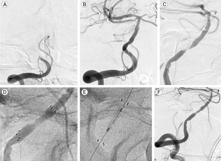 Rescue angioplasty and stenting in refractory acute vertebrobasilar occlusion after mechanical thrombectomy: A single center experience.