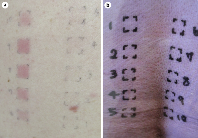 Photo-Induced Sarcoidosis in a Diabetic Patient Receiving Metformin Hydrochloride.