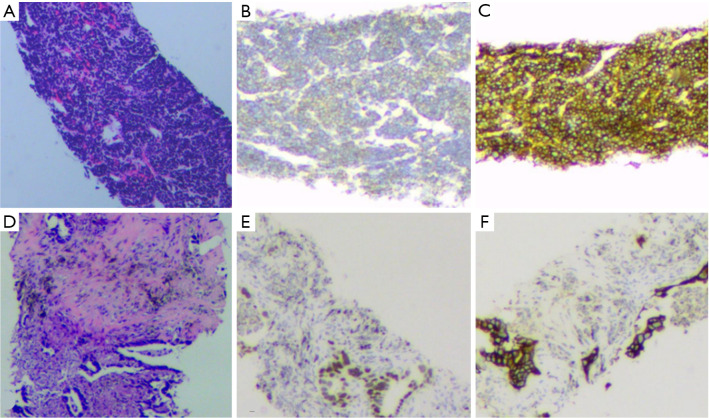 Heterogeneity and co-occurrence of resistance mechanisms in EGFR-TKI-induced NSCLC to SCLC transformation: a case report.