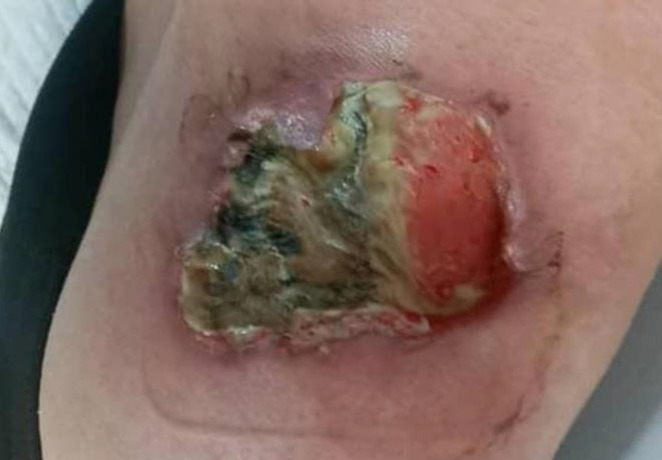 Pyoderma gangrenosum, as the first clinical presentation of systemic lupus erythematous, a case report and comprehensive literature review.