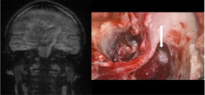 Detection of cholesteatoma recurrence by magnetic resonance imaging (DWI non-EPI sequence) - how can we minimise false results?