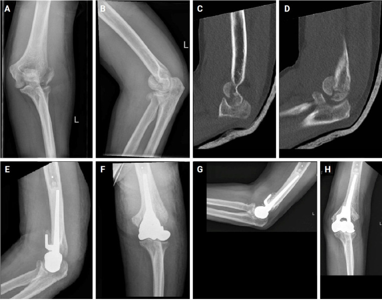 Elbow hemiarthroplasty for unreconstructible distal humerus fractures: a case series.