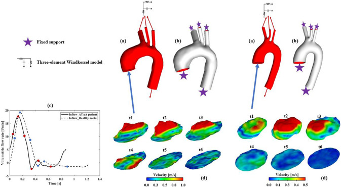 A combined 4D flow MR imaging and fluid–structure interaction analysis of ascending thoracic aortic aneurysms