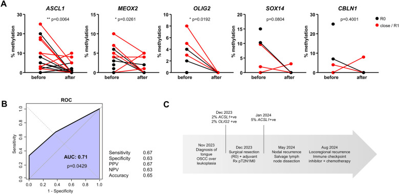 Salivary cell-free DNA methylation analysis for oncological monitoring of surgical resection of oral squamous cell carcinoma.