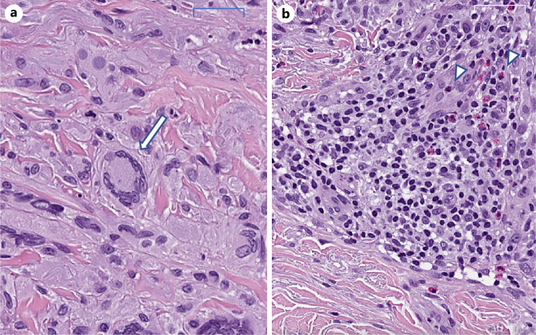 Photo-Induced Sarcoidosis in a Diabetic Patient Receiving Metformin Hydrochloride.
