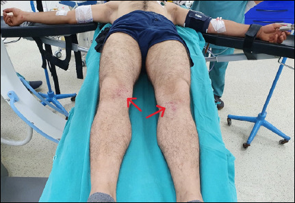 Bilateral anterior obturator hip dislocation without fracture: A rare case report with unusual etiology.