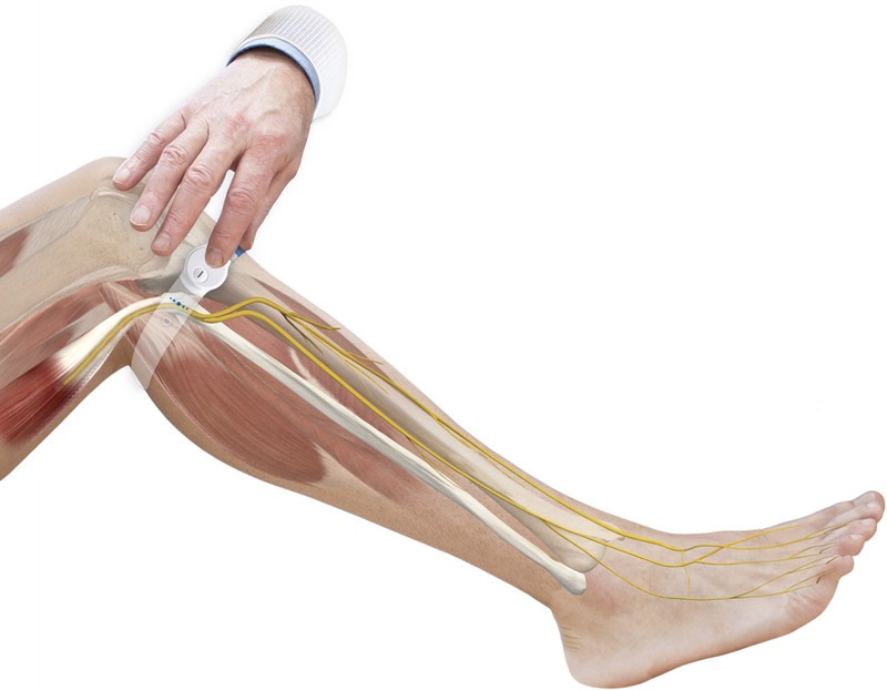 Healing Rate and Time to Closure of Venous Leg Ulcers: A Real-World Service Evaluation of Neuromuscular Electrostimulation as an Adjunct to Compression Therapy.