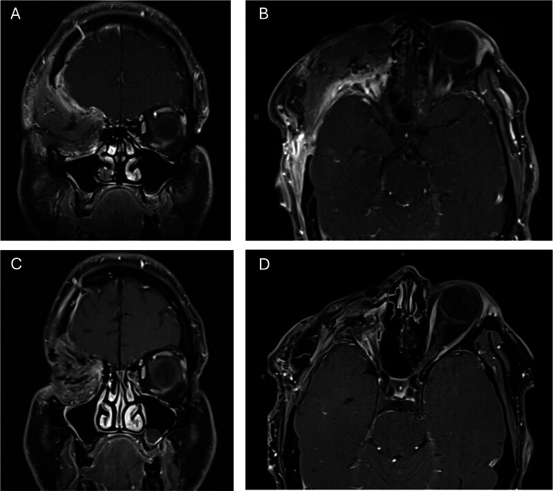 Carcinoma Ex-Pleomorphic Adenoma of the Lacrimal Gland with Intracranial Extension.