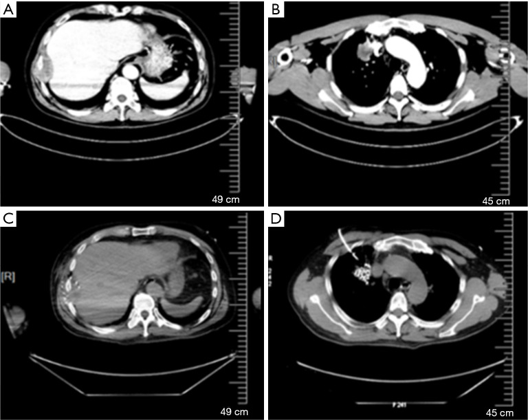 Heterogeneity and co-occurrence of resistance mechanisms in EGFR-TKI-induced NSCLC to SCLC transformation: a case report.
