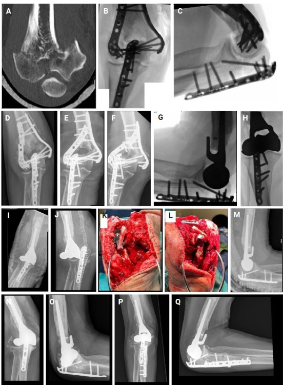 Elbow hemiarthroplasty for unreconstructible distal humerus fractures: a case series.