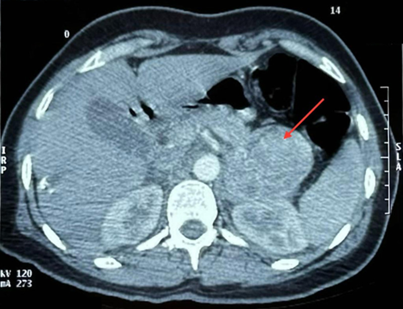 Takotsubo cardiomyopathy due to a pheochromocytoma: a case report.