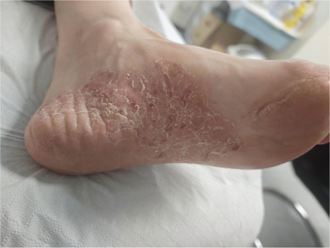 Capillaroscopic Changes in a Patient with Undifferentiated Connective Tissue Disease - A Diagnostic Challenge: A Quiz.