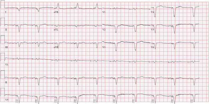 Midnight punctual tachycardia.
