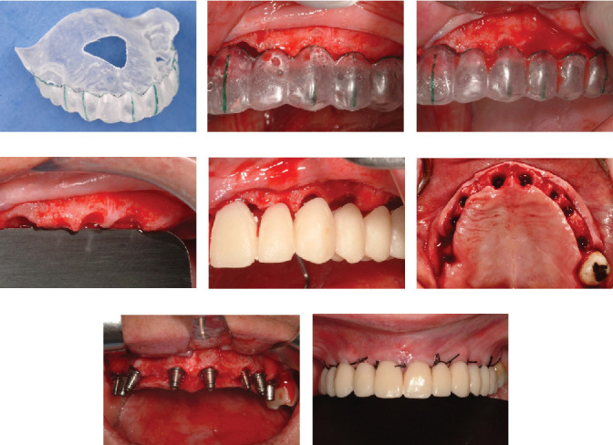 Eighteen-Year Follow-Up of Bone Sculpting Using the 3A-2B Biological Rule for Immediate and Late Implant Placement With Immediate Loading in Maxillary Fixed Prostheses: A Clinical Report.