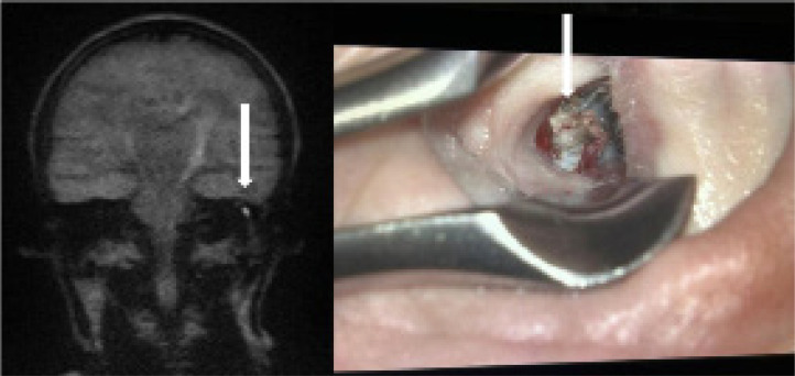 Detection of cholesteatoma recurrence by magnetic resonance imaging (DWI non-EPI sequence) - how can we minimise false results?