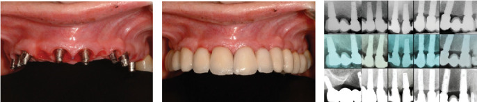 Eighteen-Year Follow-Up of Bone Sculpting Using the 3A-2B Biological Rule for Immediate and Late Implant Placement With Immediate Loading in Maxillary Fixed Prostheses: A Clinical Report.