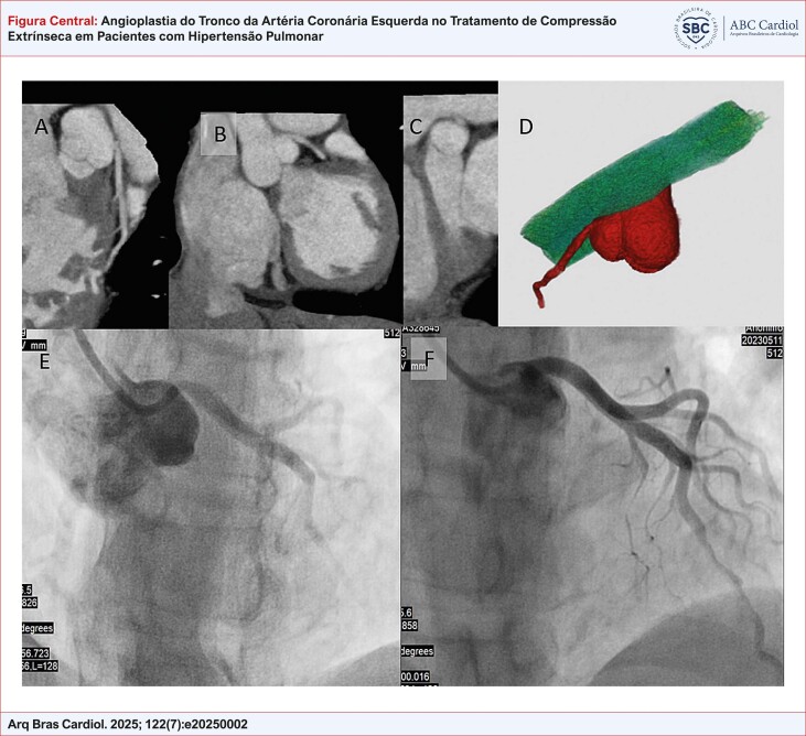 Left Main Coronary Artery Angioplasty for the Treatment of Extrinsic Compression in Patients with Pulmonary Hypertension.