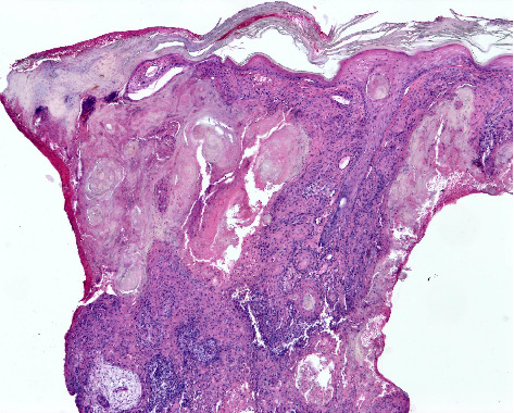 Squamous Cell Carcinoma: A Clinical and Histopathological Review of a South African Tertiary Dermatology Unit.