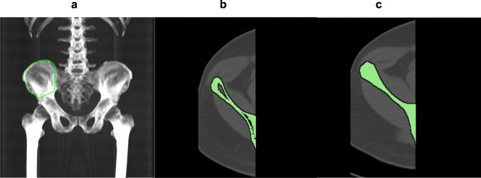 [<sup>18</sup>F]NaF PET/CT Imaging of Iliac Bones to Assess Bone Turnover.