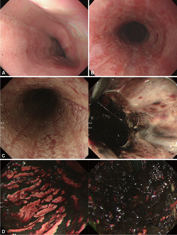 Esophageal Mucosal Injuries From Drugs, Radiation, and Caustic Agents.