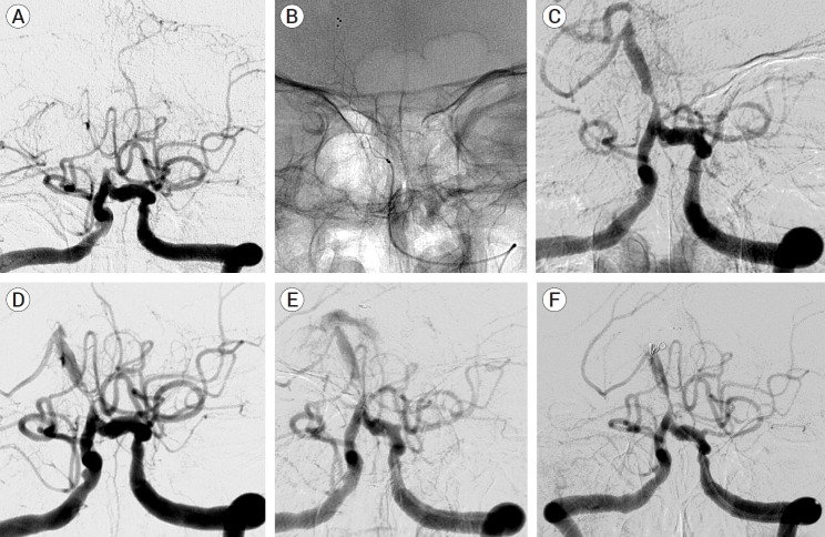 Rescue angioplasty and stenting in refractory acute vertebrobasilar occlusion after mechanical thrombectomy: A single center experience.