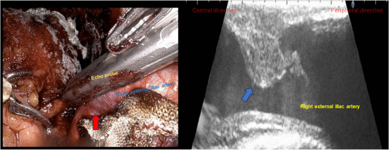 Usefulness of lower extremity pulse oximetry for detection of external iliac artery dissection during robot-assisted radical prostatectomy.