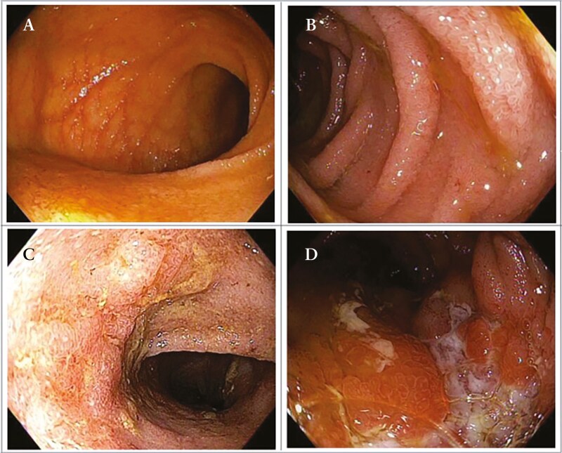 Histologic and Endoscopic Findings Are Highly Correlated in a Prospective Cohort of Patients With Inflammatory Bowel Diseases.