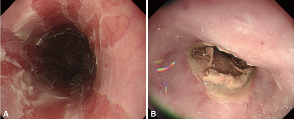 Esophageal Mucosal Injuries From Drugs, Radiation, and Caustic Agents.