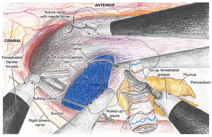 Intraoperative complications during robotic thymectomy and their management: a narrative review.
