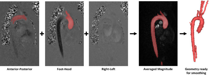 A combined 4D flow MR imaging and fluid–structure interaction analysis of ascending thoracic aortic aneurysms