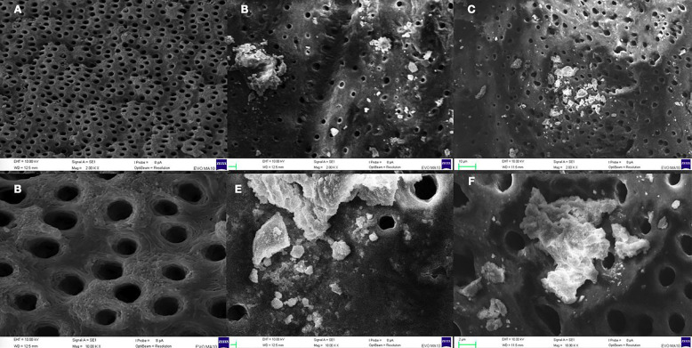 Bioceramic dressing and its influence on intratubular penetration and bond strength of endodontic sealers.