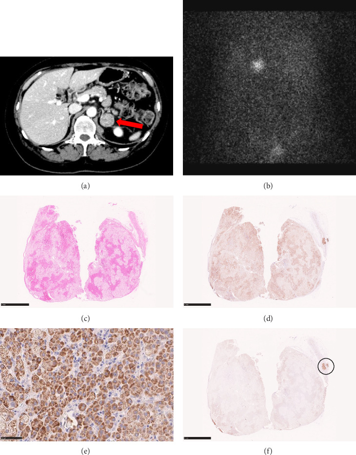 Unexpected Remission of Bilateral Hyperaldosteronism After Unilateral Cortisol-Producing Adenoma Resection: A Report of Two Cases.
