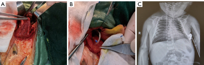 Application of nasojejunal nutrition tube after surgery for congenital gastric wall muscle layer defect in neonates.
