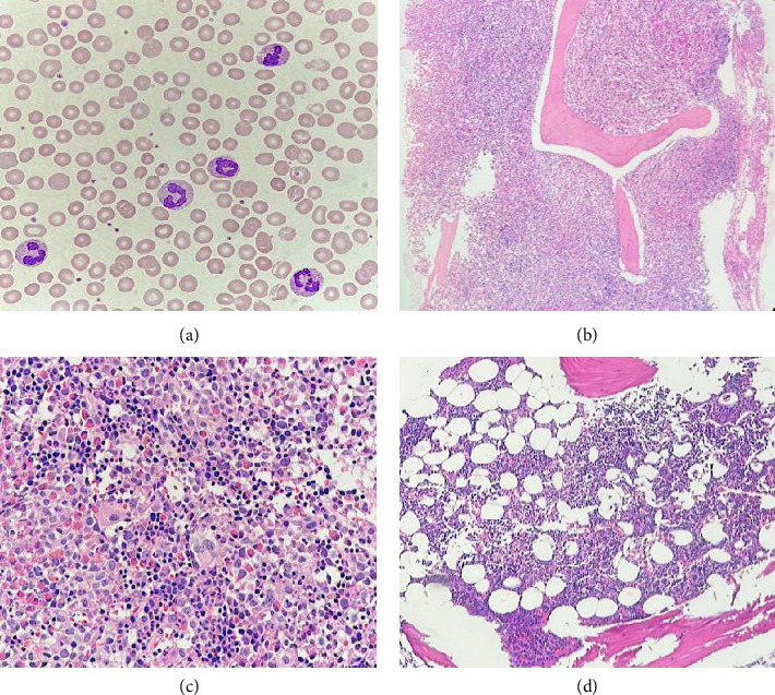 <i>MPRIP::PDGFRB</i> Fusion Gene: A Rare Case Report of Adult Myeloid/Lymphoid Neoplasm With Eosinophilia and Tyrosine Kinase Gene Fusions.