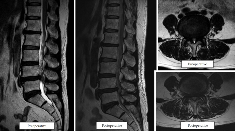 Biportal Endoscopic Decompression for Degenerative Lumbar Spondylolisthesis With Stenosis.