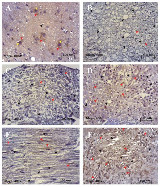 Inhibitory effect of MLC901 on axonal demyelination in experimental animals undergoing circumferential lumbal stenosis by increasing transforming growth factor-β1 levels.
