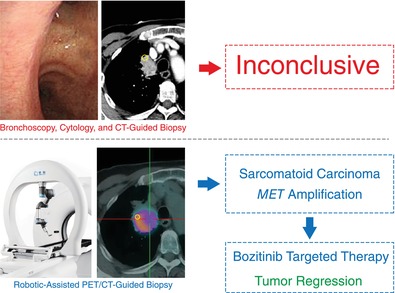 Enhancing the Precision and Efficiency of Pulmonary Tumor Detection With Robotic-Assisted <sup>18</sup>F-FDG PET/CT-Guided Lung Biopsy: A Case Report.