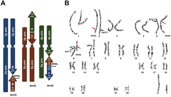 Identification of De Novo Chromosomal Translocations Disrupting NIPBL in a Patient With Cornelia de Lange Syndrome by Full Genome Analysis.