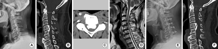 The Role of K-Line and Canal-Occupying Ratio in Surgical Outcomes for Multilevel Cervical Ossification of the Posterior Longitudinal Ligament: A Retrospective Multicenter Study.