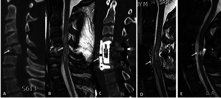 Mechanisms of Traumatic Spinal Cord Injury AIS Grade Conversion.