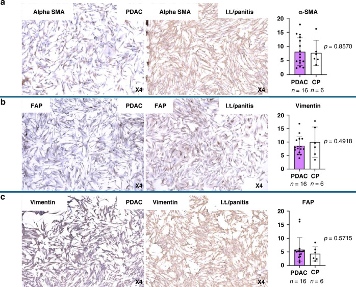 The influence of clinical risk factors on the classification of human cancer-associated fibroblasts in PDAC and pancreatitis patients.