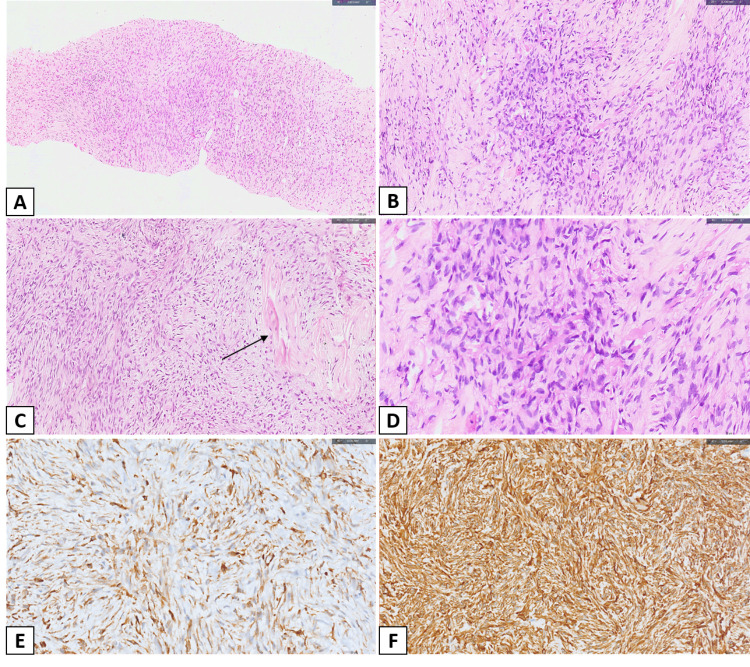 Low-grade fibromyxoid sarcoma, a rare tumor at an unusual site: Case report and review of literature.