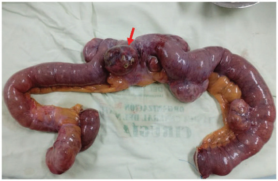 Complicated Diverticular Disease of the Small Bowel: A Rare Cause of Acute Abdomen in a Critically Ill Patient-A Case Report.
