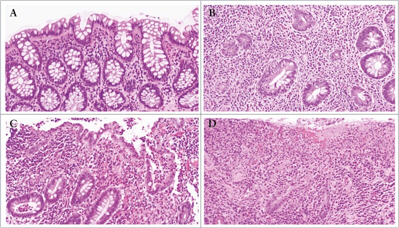 Histologic and Endoscopic Findings Are Highly Correlated in a Prospective Cohort of Patients With Inflammatory Bowel Diseases.