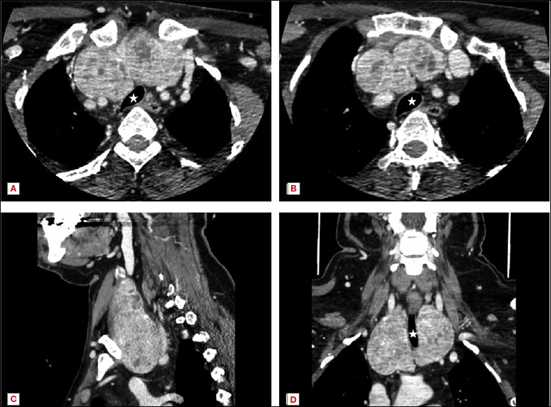 Surgical approaches to the management of the intrathoracic goiter - A systematic review.