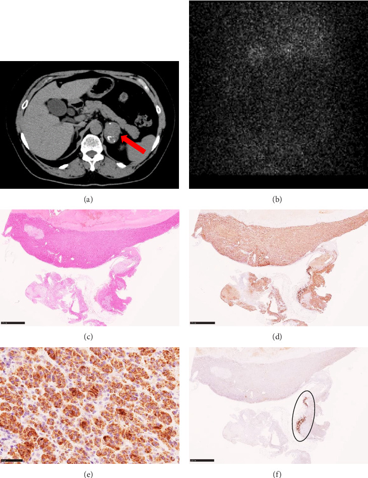 Unexpected Remission of Bilateral Hyperaldosteronism After Unilateral Cortisol-Producing Adenoma Resection: A Report of Two Cases.