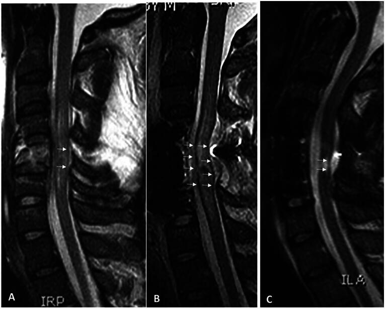 Mechanisms of Traumatic Spinal Cord Injury AIS Grade Conversion.