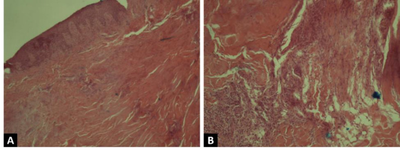 Pyoderma gangrenosum, as the first clinical presentation of systemic lupus erythematous, a case report and comprehensive literature review.
