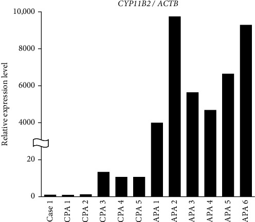 Unexpected Remission of Bilateral Hyperaldosteronism After Unilateral Cortisol-Producing Adenoma Resection: A Report of Two Cases.
