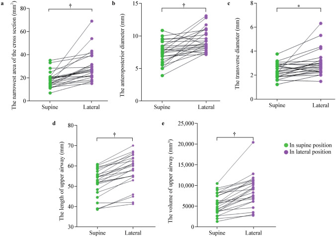 Impact of lateral positioning on upper airway morphology in sedated children under five.